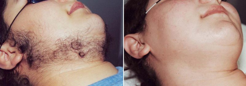 PCOS-laser-hair-removal