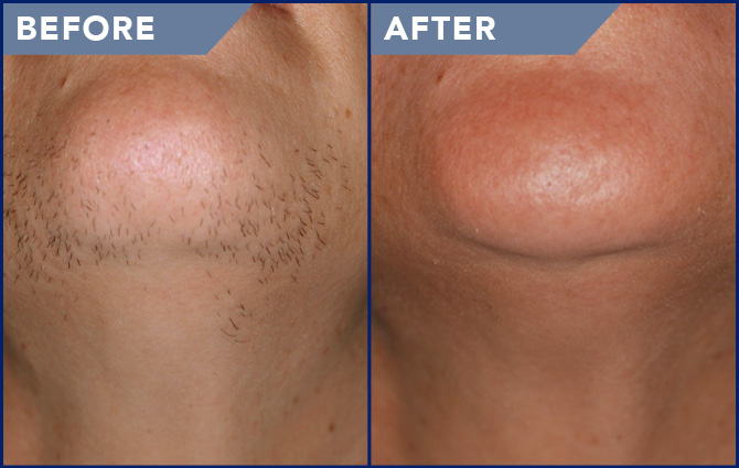 laserhair removal
