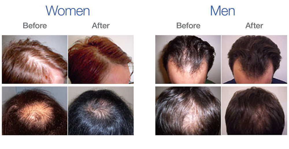 male prp hair