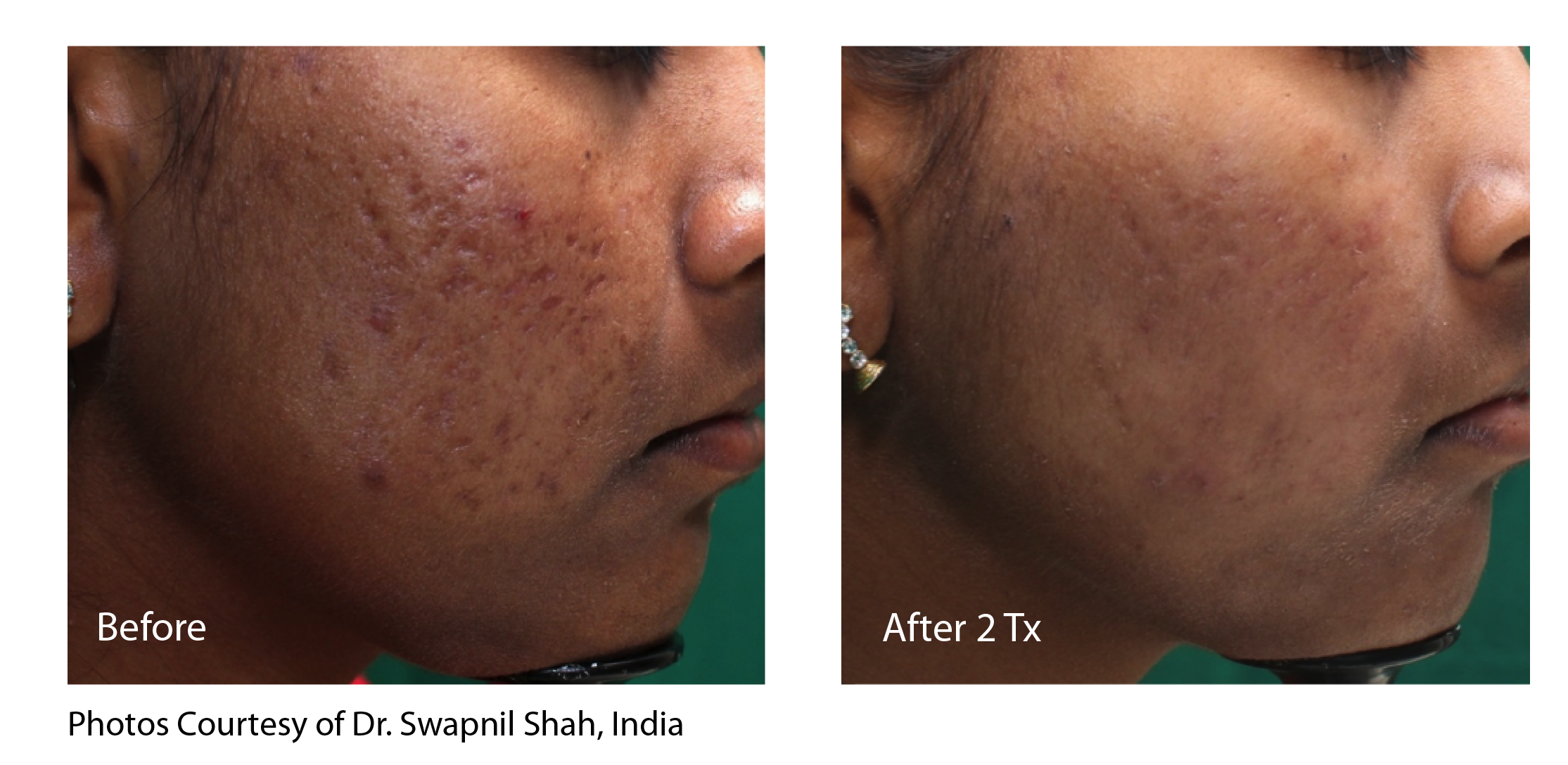 scar removal