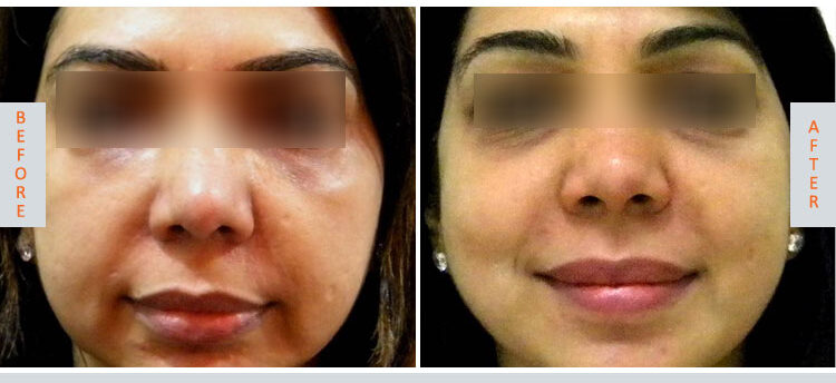 Anti Aging Treatment for Face