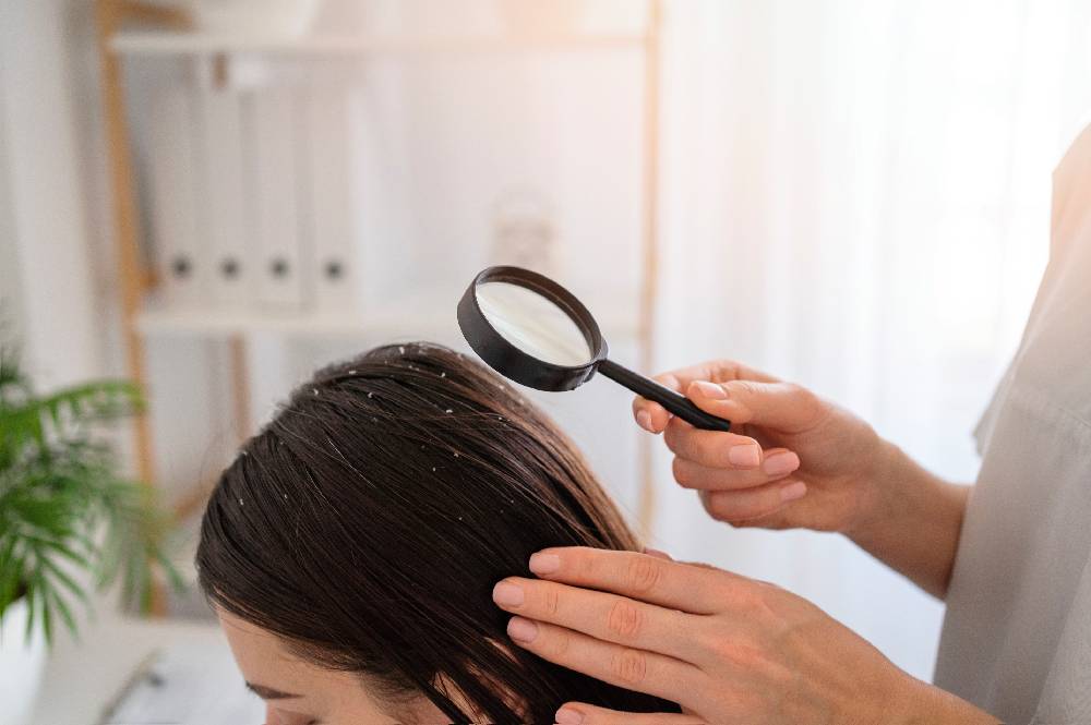 dandruff (1)