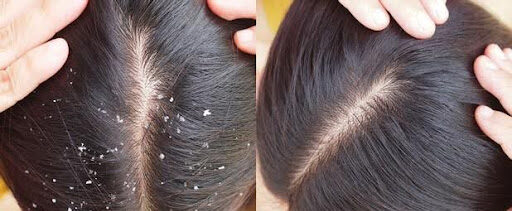 dandruff