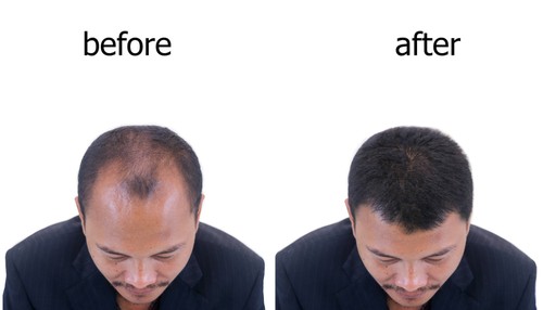 hair tranplantaion
