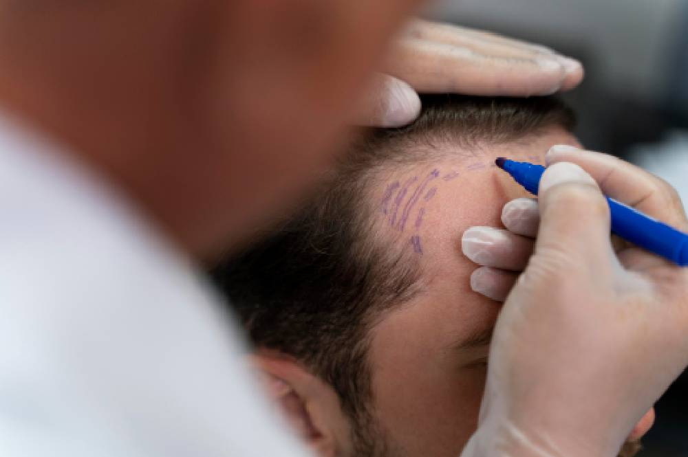 hair-transplant (1)