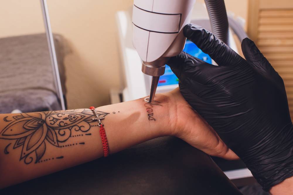 tattoo-removal