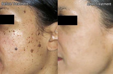 wart-removal