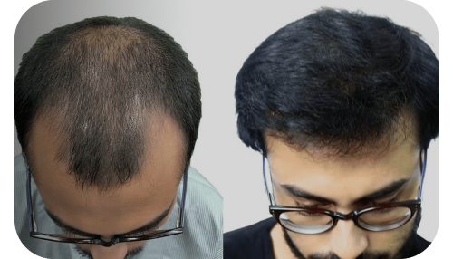 Hair-Transplant-grade5